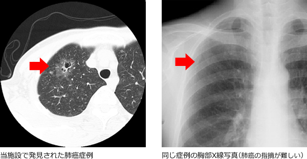 肺_CT検査
